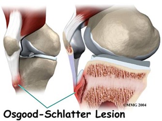 Osgood Schlatters Disease