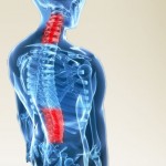 herniated disc