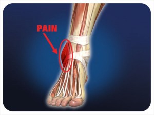 ankle sprain