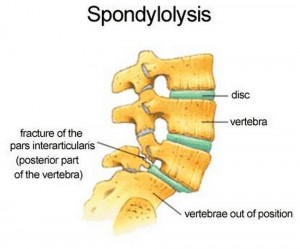 Spondylolysis