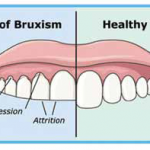 Effects of Bruxism