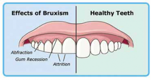Effects of Bruxism