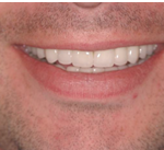 bruxism after