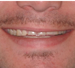 bruxism before