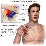 Thoracic_Outlet_Syndrome