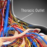 thoracic-outlet-syndrome