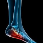 plantar fasciitis