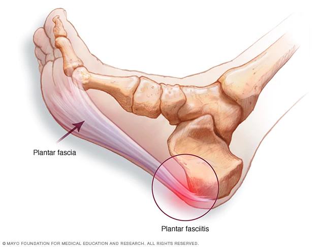 plantar fasciitis