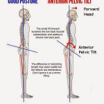 anterior-pelvic-tilt