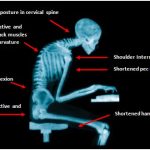 x-ray-of-bad-posture