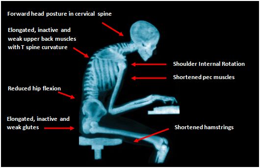x-ray-of-bad-posture - Biokineticist Andries Lodder | Bio4Me