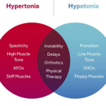 Hypertonicity-vs-Hypotonicity