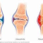 Arthritis-Types